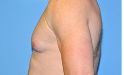 Gynecomastia Before and After Pictures Plano, TX