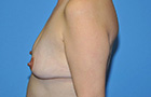 Breast Augmentation Before and After Pictures Plano, TX