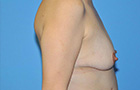 Breast Augmentation Before and After Pictures Plano, TX