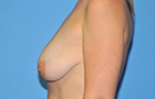 Breast Augmentation Before and After Pictures Plano, TX