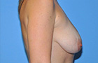 Breast Augmentation Before and After Pictures Plano, TX