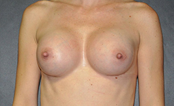 Breast Augmentation Before and After Pictures Plano, TX