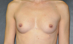 Breast Augmentation Before and After Pictures Plano, TX