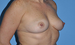 Breast Augmentation Before and After Pictures Plano, TX