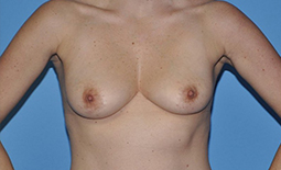 Breast Augmentation Before and After Pictures Plano, TX