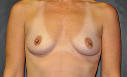 Breast Augmentation Before and After Pictures Plano, TX