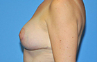 Breast Lift Before and After Pictures Plano, TX