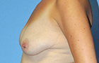 Breast Lift Before and After Pictures Plano, TX