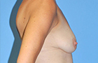 Breast Lift Before and After Pictures Plano, TX