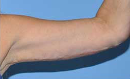Arm Lift Before and After Pictures Plano, TX