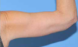 Arm Lift Before and After Pictures Plano, TX