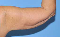 Arm Lift Before and After Pictures Plano, TX