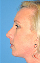 Chin Augmentation Before and After Pictures Plano, TX