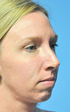 Chin Augmentation Before and After Pictures Plano, TX