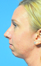 Chin Augmentation Before and After Pictures Plano, TX