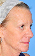 Facelift Before and After Pictures Plano, TX