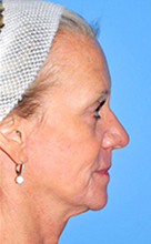 Facelift Before and After Pictures Plano, TX