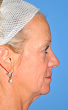 Facelift Before and After Pictures Plano, TX