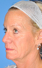 Facelift Before and After Pictures Plano, TX