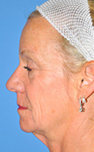 Facelift Before and After Pictures Plano, TX