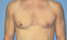 Gynecomastia Before and After Pictures Plano, TX