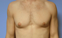 Gynecomastia Before and After Pictures Plano, TX