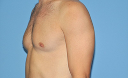 Gynecomastia Before and After Pictures Plano, TX