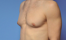 Gynecomastia Before and After Pictures Plano, TX