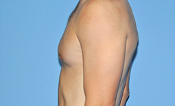 Gynecomastia Before and After Pictures Plano, TX