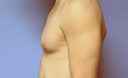 Gynecomastia Before and After Pictures Plano, TX