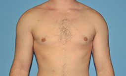 Gynecomastia Before and After Pictures Plano, TX