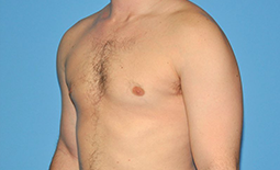 Gynecomastia Before and After Pictures Plano, TX