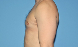 Gynecomastia Before and After Pictures Plano, TX