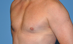 Gynecomastia Before and After Pictures Plano, TX