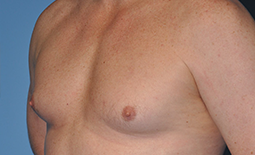 Gynecomastia Before and After Pictures Plano, TX