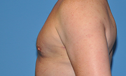 Gynecomastia Before and After Pictures Plano, TX