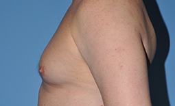 Gynecomastia Before and After Pictures Plano, TX