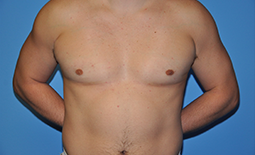 Gynecomastia Before and After Pictures Plano, TX