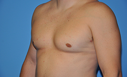 Gynecomastia Before and After Pictures Plano, TX