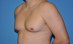 Gynecomastia Before and After Pictures Plano, TX