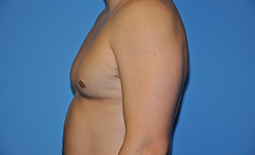 Gynecomastia Before and After Pictures Plano, TX