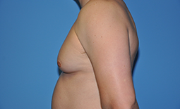 Gynecomastia Before and After Pictures Plano, TX