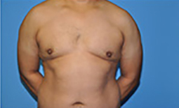 Gynecomastia Before and After Pictures Plano, TX