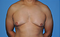 Gynecomastia Before and After Pictures Plano, TX