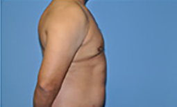 Gynecomastia Before and After Pictures Plano, TX