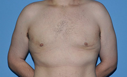 Gynecomastia Before and After Pictures Plano, TX