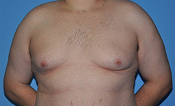 Gynecomastia Before and After Pictures Plano, TX