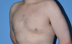 Gynecomastia Before and After Pictures Plano, TX