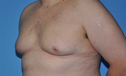 Gynecomastia Before and After Pictures Plano, TX