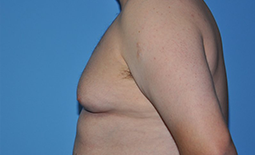 Gynecomastia Before and After Pictures Plano, TX